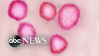 Officials warn coronavirus will affect more Americans after Chicago woman diagnosed