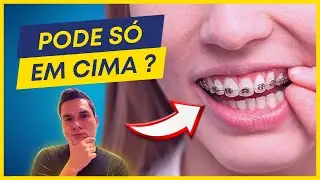 PODE COLOCAR APARELHO ORTODÔNTICO SÓ EM CIMA? VERDADE REVELADA.