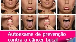 Como fazer o autoexame de prevenção do cancer de boca?