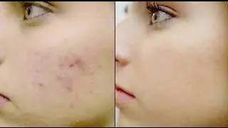 TIPS PERAWATAN WAJAH AGAR LEBIH CERAH,BEKAS JERAWAT HILANG DAN NODA HITAM
