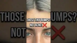 HOW TO GET RID OF TINY FOREHEAD BUMPS!?#skincare #glowup #viral #acne #trendy #fypシ #shortvideo