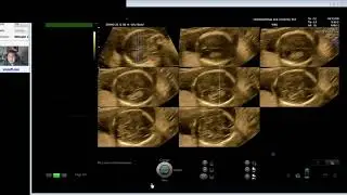 BODY STALK ANOMALIES/ LIMB BODY WALL DEFECTS/ MIDLINE DEFECTS (Dr Wiku Andonotopo)