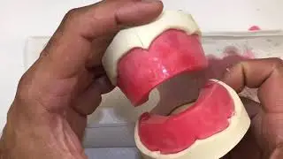 9d) Finalizing Maxillary & Mandibular Occlusion Rims