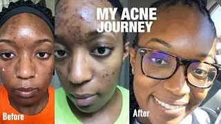 MY ACNE JOURNEY: How I cleared my skin | ACNE.ORG