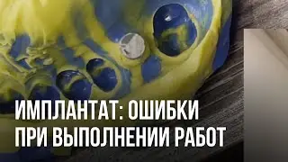 Имплантат: ошибки при выполнении работ на имплантатах. Аналог и трансфер
