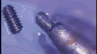 Implant Rescue Academy - Double Dental  Implant Screw Fracture - a unique rescue case 5 of 5