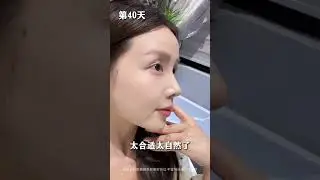 Apakah Anda ingin memperbaiki hidung Anda?#noselift #Noserepair #Rhinoplasty #nosejob