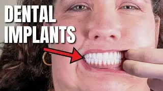 Can You Really Afford Dental Implants Without Breaking The Bank?