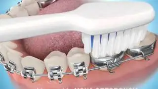 Técnica de cepillado con brackets