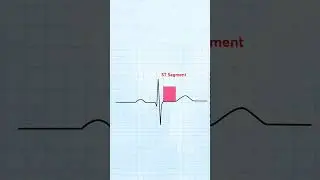 ECG Report Ko Kesa Padhe | How To Read ECG Report | #ecg #health #shorts