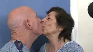 Tandem Facelift for Couple in Their 70s
