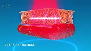 #Emsculpt #Neo - How does it work? #BTL