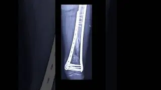 Dual Plate for Distal Femur #ortho #trauma #science
