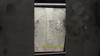 THIS PATIENT HAS MULTIPLE NEPHROLITHIASIS