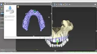 Straumann coDiagnostix Single Implant Guide with AI Assistant