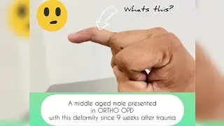 Mallet Finger (Sports Injury 🤾🏻&zwj;♂️)~ انگلی کا ٹیڑھا پن