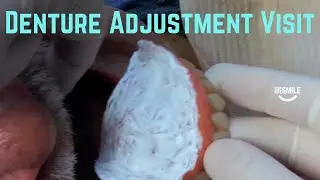 Denture follow up visit