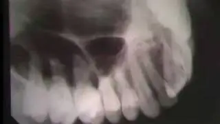 Occlusal Radiography