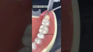 Impacted Wisdom Tooth Removal #youtubeshorts #viral #shorts #trending #wisdomteeth