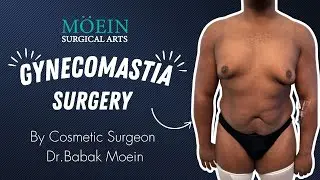 Male Chest Transformation | Gynecomastia Surgery by Dr. Moein 💪