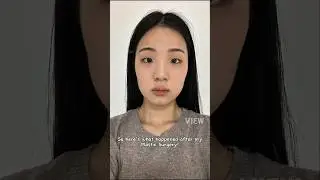 Korean Plastic Surgery Review:  Rhinoplasty, Facial Contouring, Double Eyelid Surgery #nosejobs