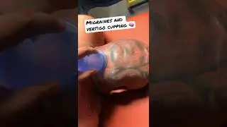 Migraines and Vertigo Head Cupping 😳🤯