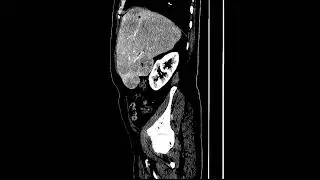 meta liver mass dt lung