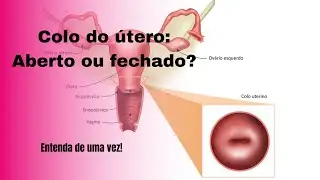 COMO SABER SE O COLO DO ÚTERO ESTÁ ABERTO OU FECHADO?