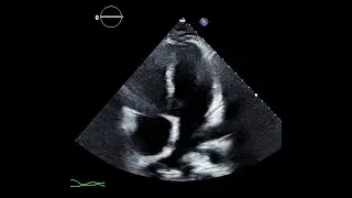 Transthoracic Echocardiogram Showing Signs of Constrictive Physiology