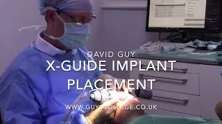 X-Guide dental implant placement intro by David Guy