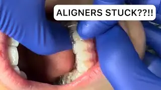 Extreme Aligner Removal 😱 Crowded Teeth + Attachments = This&hellip;