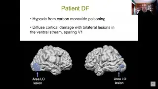 Mel Goodale: How DF and other single-cases have illuminated our understanding of the visual pathways
