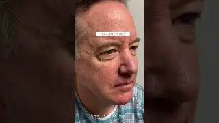 Upper and Lower Blepharoplasty for Men | Quadfecta Lift with Dr. Kami Parsa