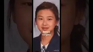 Rose before and after plastic surgery #blackpinkrose #roseplasticsuergery