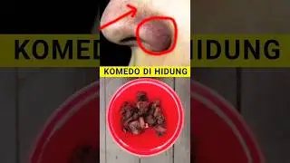 CARA MEMBERSIHKAN KOMEDO DI HIDUNG