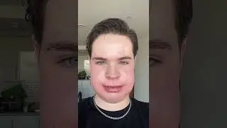 Extreme swelling: double jaw surgery journey #doublejawsurgery