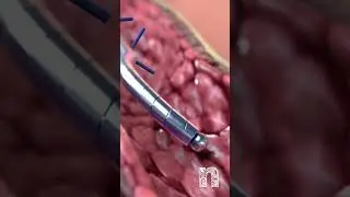 🚀 Revolutionize Vascular Interventions with Redwire Guidewires | Medical Animation