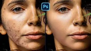 ACNE REMOVAL ⚡ Photoshop Tutorial