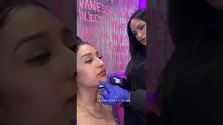 Chin filler for profile balance ✨#chinfiller #lipfiller #beauty #houstoninjector