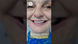 Зубы прошли проверку шашлыком. Имплантация зубов. #dentist