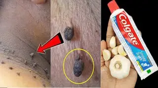 REMOVE SKIN TAGS OVERNIGHT WITH TOOTHPASTE REMEDY | HOW TO GET RID OF SKIN TAGS NATURALLY AT HOME