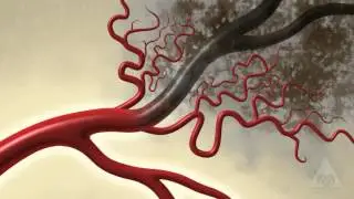 EECP And Stroke Therapy    Global Cardio Care