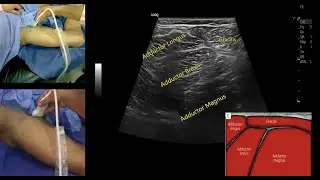 Adductors Approach, Online MSK & Doppler Courses