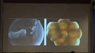 AIOC2022 IC399 topic Dr  MANISH TANDON PRP SCATTER LASER PHOTOCOAGULATION  DESIRABLE TECHNIQUE