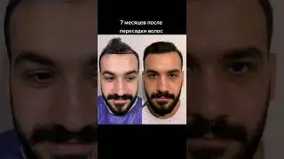 Пересадка волос в Турции | Результат после пересадки волос техникой FUE Sapphire