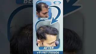 Best Hair Transplant Clinic in Delhi | Before After Best Results | Cost of Hair Transplant in Delhi