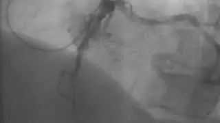 Transradial Access - Video 5.9