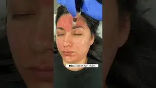 MICRONEEDLING BENEFITS
