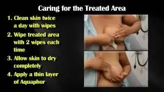 How to Care for your Skin during Breast Cancer Radiation Therapy