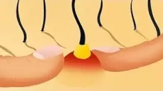 &iquest;Qu&eacute; hay realmente adentro de una espinilla? &iexcl;Nunca las revientes!